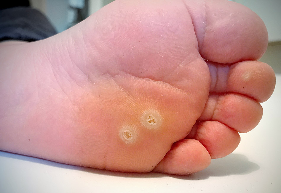 Foot with warts